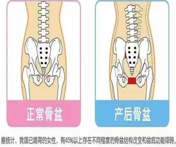 产后修复骨盆